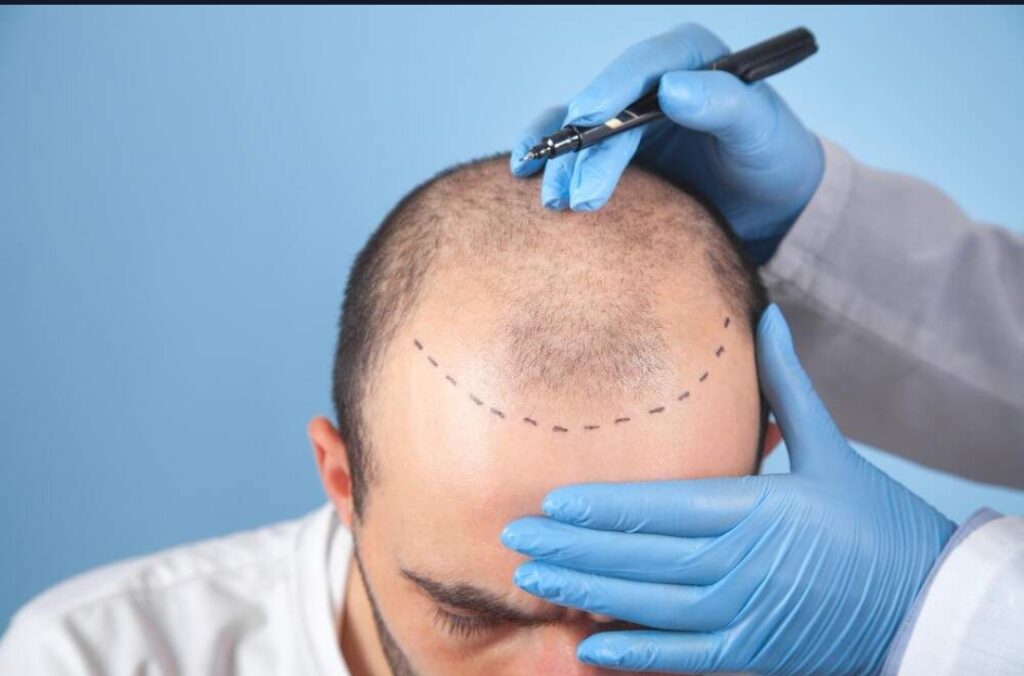 Tricopigmentation en Vendée : la solution contre la perte de cheveux